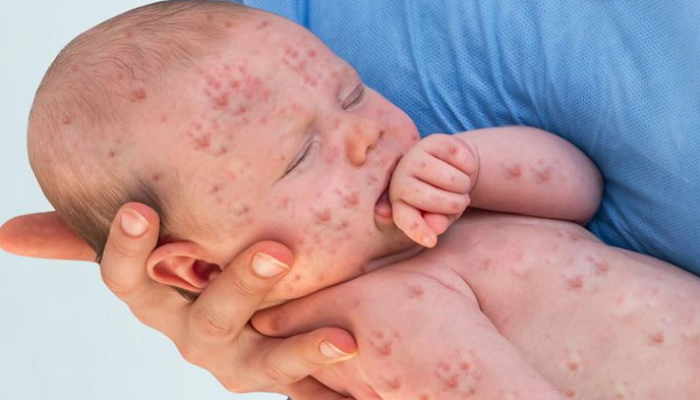 Lahcen Hammouch : “Urgence sanitaire au Maroc : L’épidémie de rougeole en hausse”