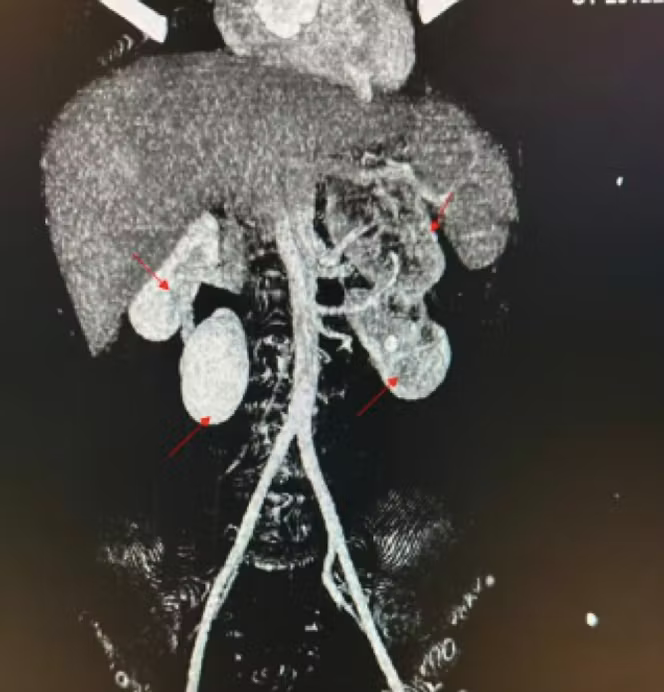 Scanner avec produit de contraste. Reconstruction volumétrique 3D. Reins surnuméraires bilatéraux : fusion à droite et à gauche.