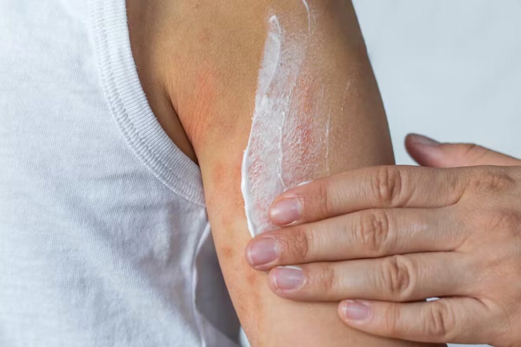 Journée nationale de l'eczéma : probiotiques et anticorps, deux pistes de traitement prometteuses Journée nationale de l'eczéma : probiotiques et anticorps, deux pistes de traitement prometteuses