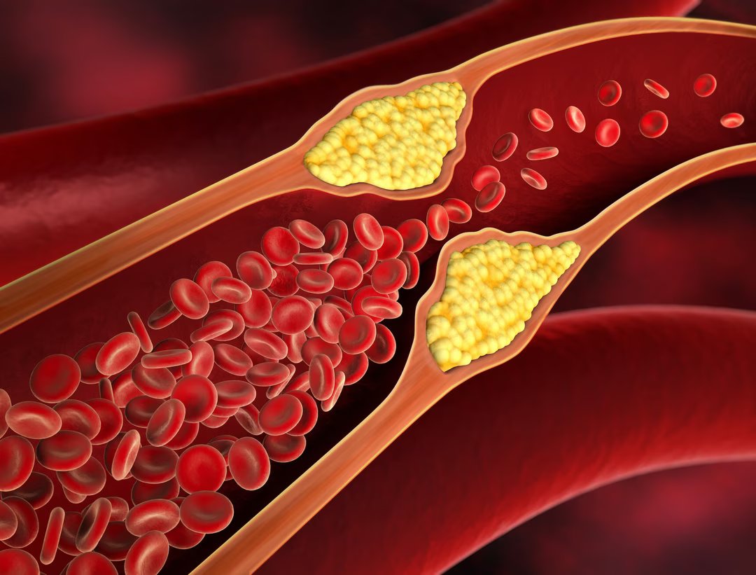 cholesterol plaque