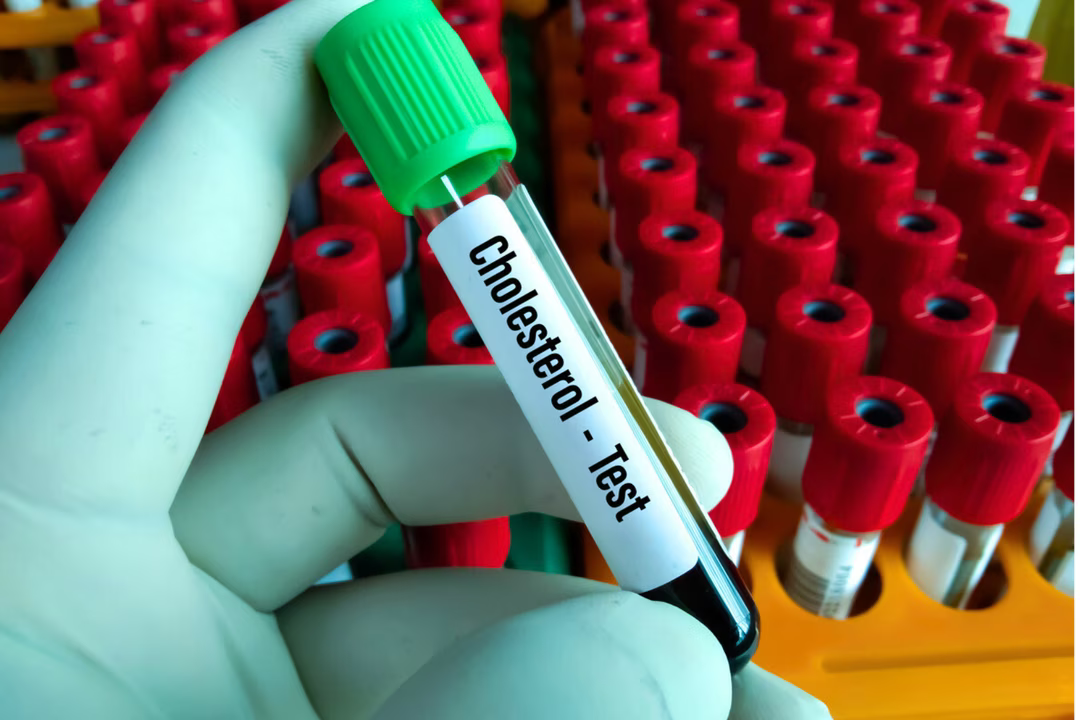 Voici les 6 signes qui devraient vous alerter sur un possible excès de cholestérol selon les médecins 1 symptomes cholesterol