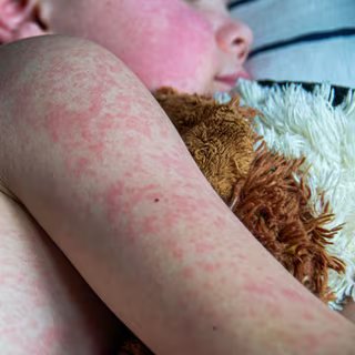 Rougeole : ce qui se passe en ce moment aux États-Unis est particulièrement inquiétant 3 La maladie a entraîné des hospitalisations pour près d'un tiers des cas (144), surtout des enfants de moins de cinq ans et des adultes de plus de 30 ans. © Povorozniuk Liudmyla, Getty Images